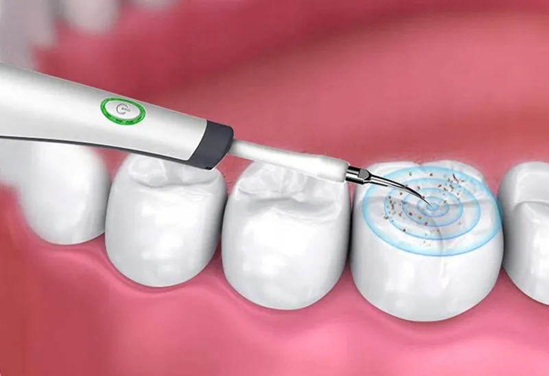 Ultrazvukový čistič na zuby a zubný kameň biely