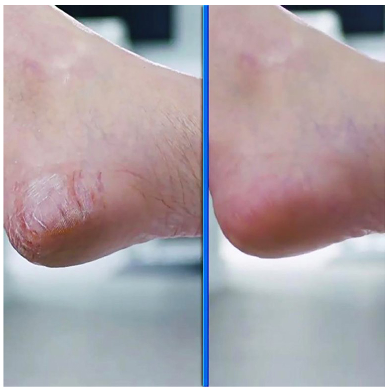 Pedi Vac Elektrická brúska na pedikúru 