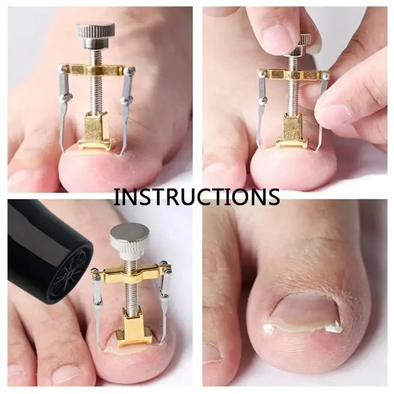 Pomôcka na zarastajúce nechty – profesionálna sada na domácu úľavu