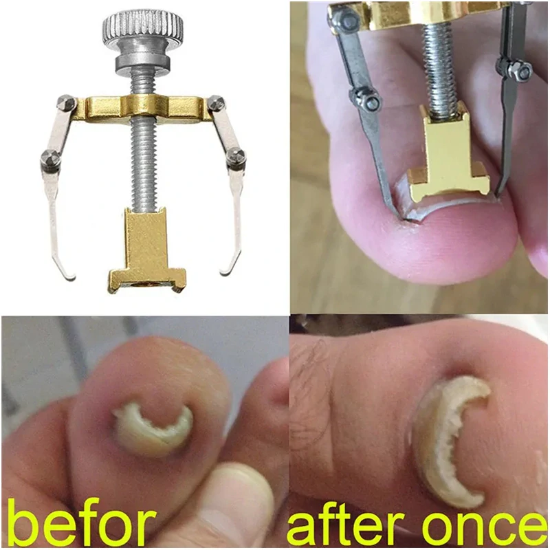 Pomôcka na zarastajúce nechty – profesionálna sada na domácu úľavu